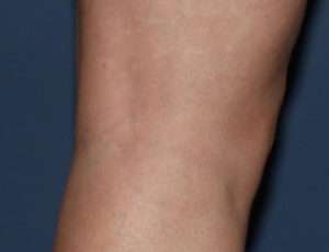 Image of a woman's legs after vein treatments
