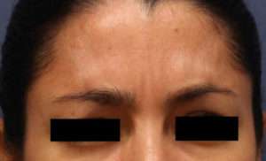 Woman's foreheads after Botox®/Dysport® treatments