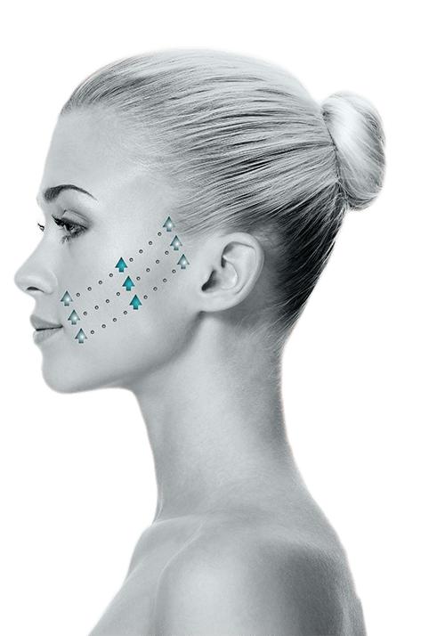Silhouette InstaLift™ Skin Treatment