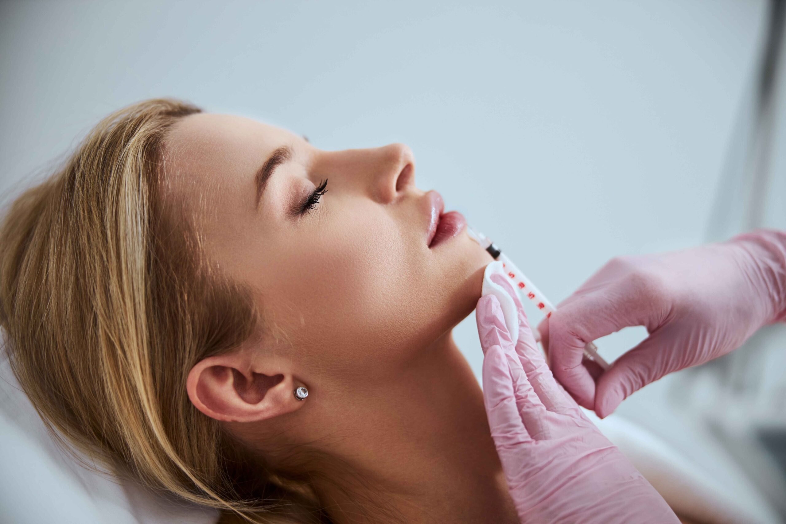 Image of a woman before dermal filler treatment